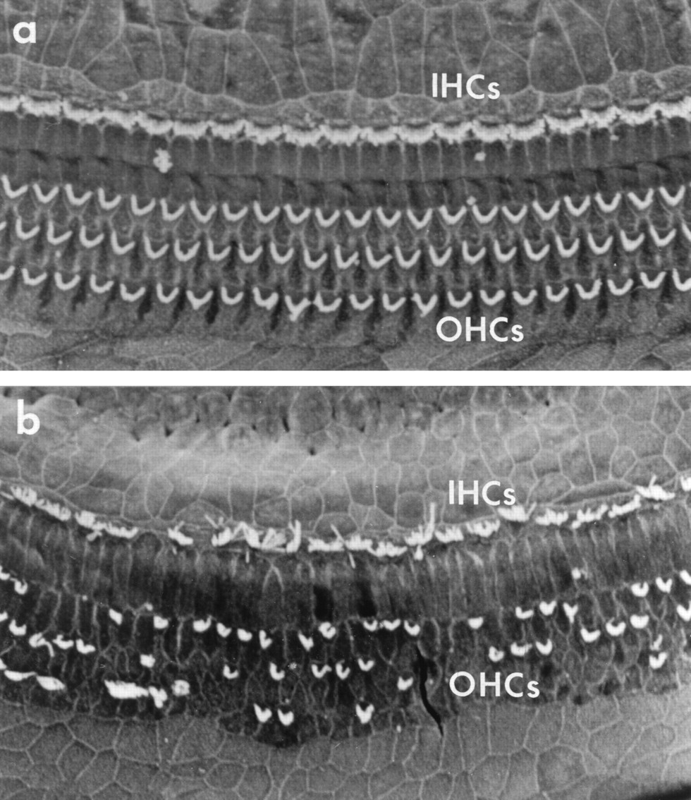 Weergave binnenste (IHC) en buitenste haarcellen (OHC), boven gezonde situatie onder beschadigde situatie bijvoorbeeld door blootstelling aan chemicaliën.